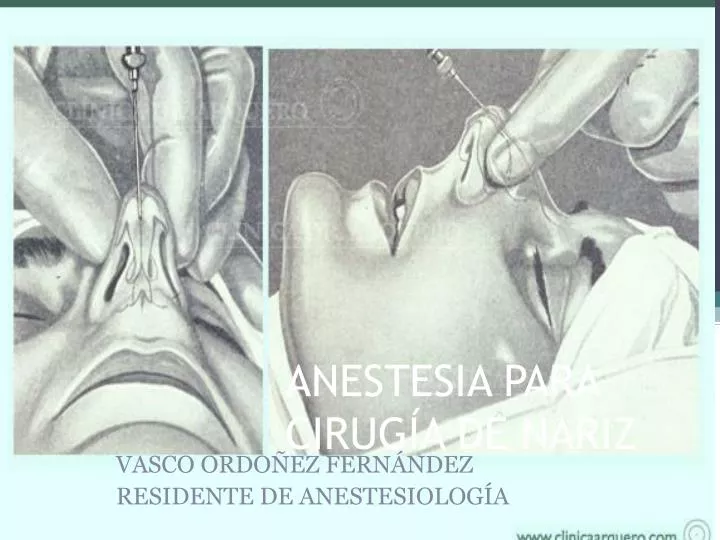 anestesia para cirug a de nariz