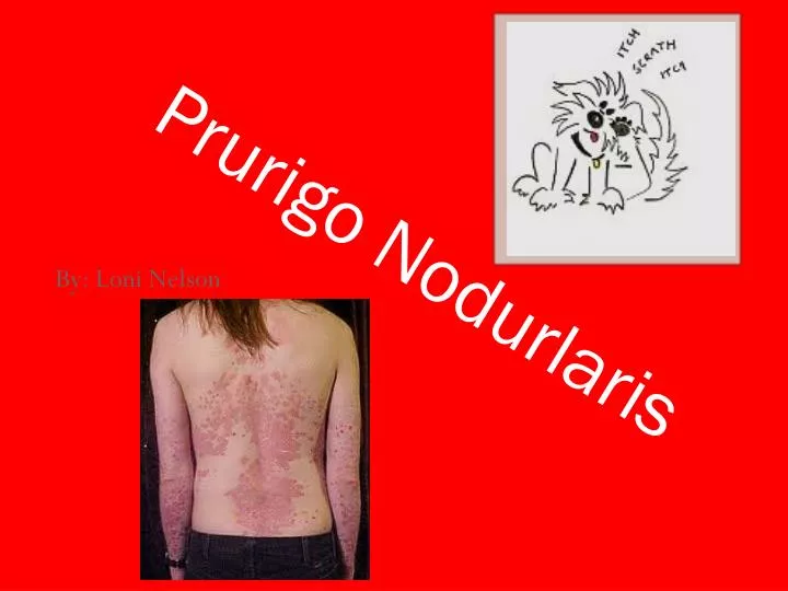 prurigo nodurlaris