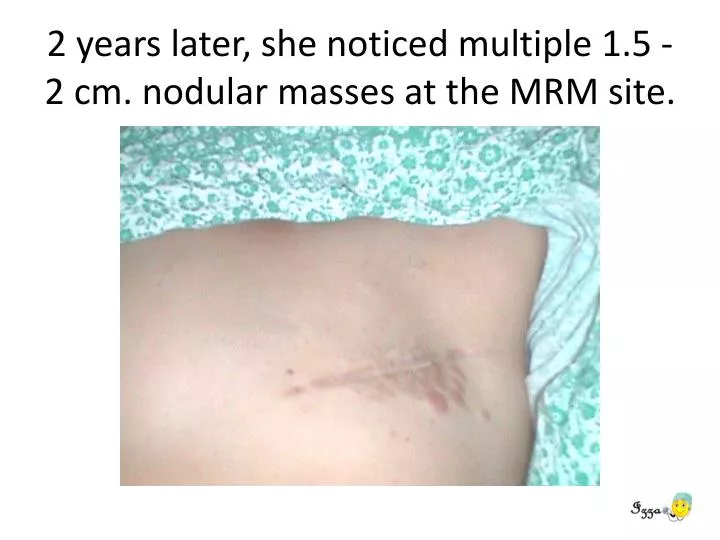 2 years later she noticed multiple 1 5 2 cm nodular masses at the mrm site