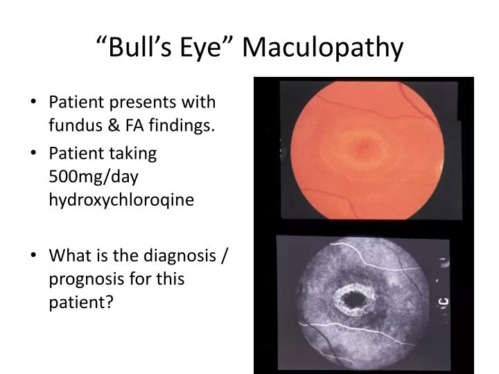 bull s eye maculopathy