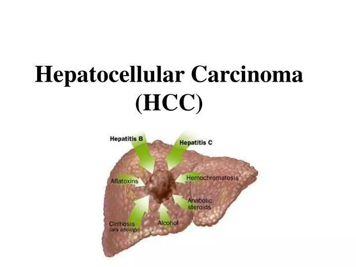 hepatocellular carcinoma hcc