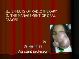 ILL EFFECTS OF RADIOTHERAPY IN THE MANAGEMENT OF ORAL CANCER
