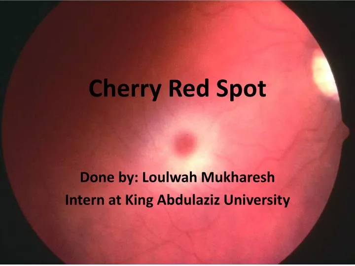cherry red spot