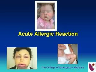 Acute Allergic Reaction