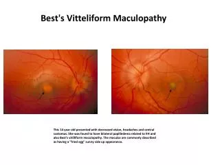 Best's Vitteliform Maculopathy
