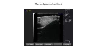 TC annular ligament collateral lateral