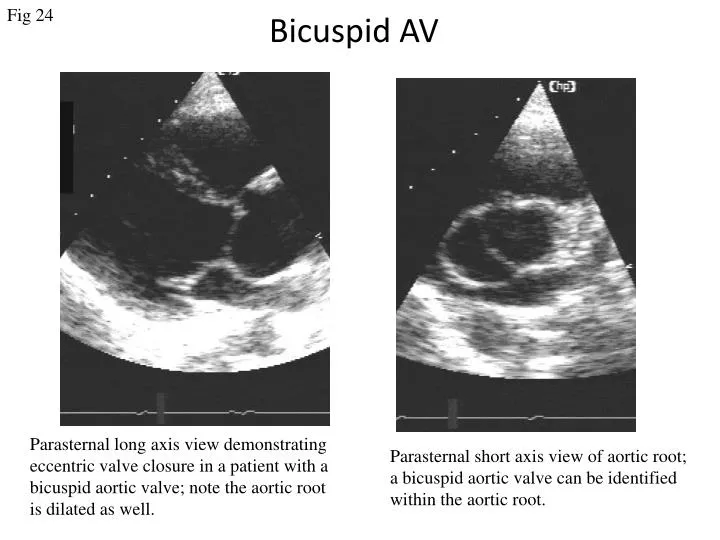 bicuspid av