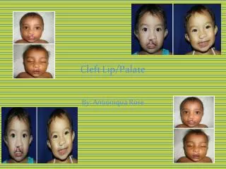 Cleft Lip/Palate