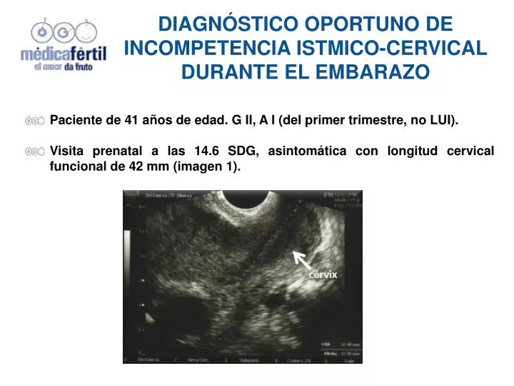 diagn stico oportuno de incompetencia istmico cervical durante el embarazo
