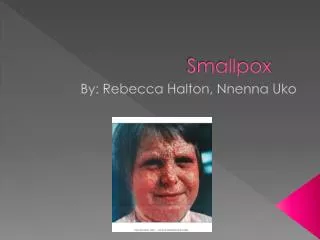 Smallpox