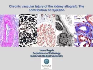 Chronic vascular injury of the kidney allograft: The contribution of rejection
