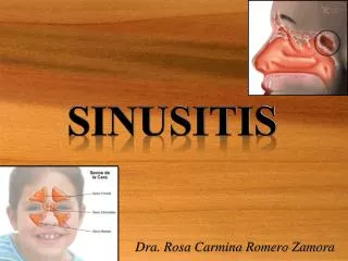 sinusitis