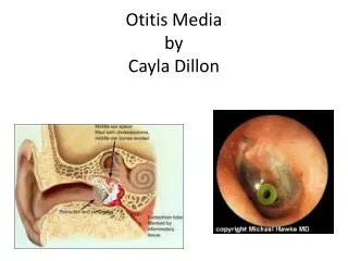 Otitis Media by Cayla Dillon