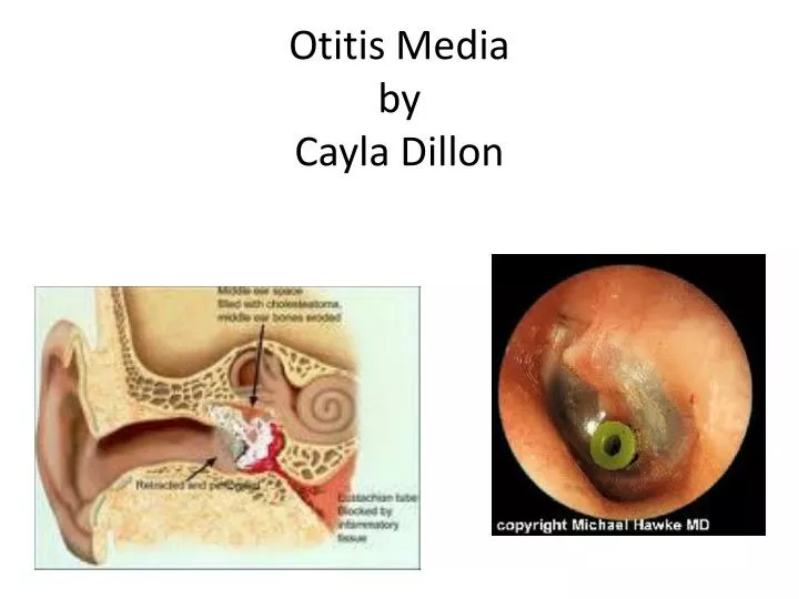 otitis media by cayla dillon