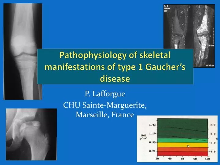 pathophysiology of skeletal manifestations of type 1 gaucher s disease