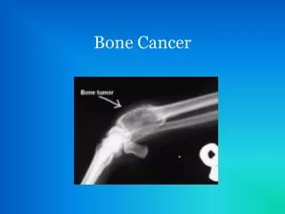 bone cancer