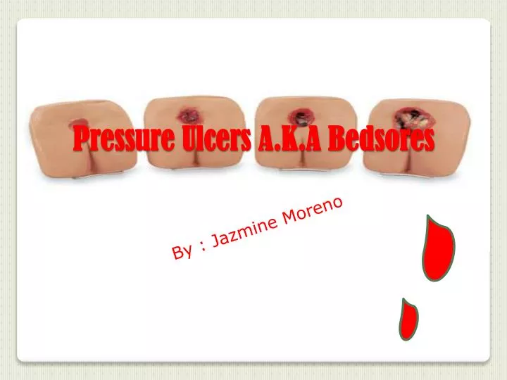 pressure ulcers a k a bedsores