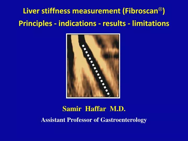 liver stiffness measurement fibroscan principles indications results limitations