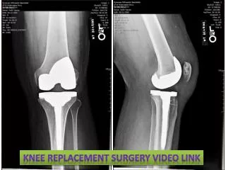 Knee Replacement Surgery Video Link