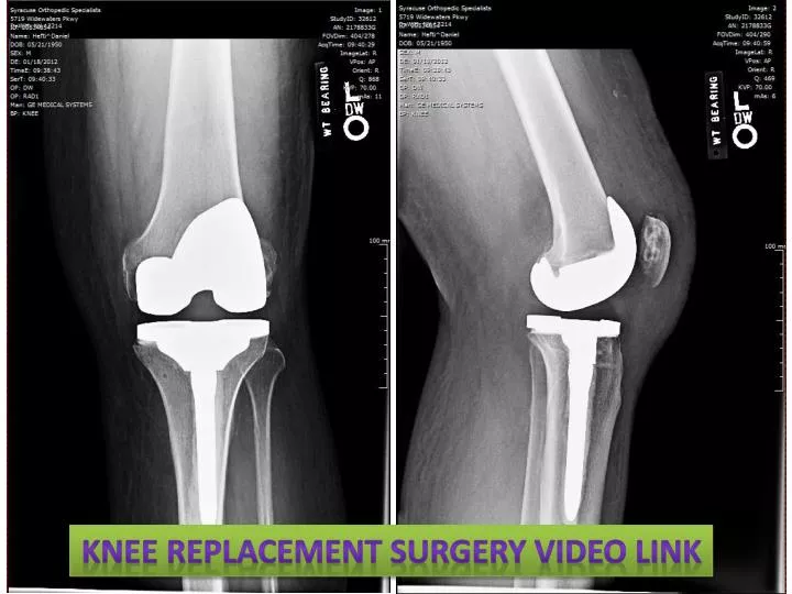 PPT - Knee Replacement Surgery Video Link PowerPoint Presentation, free  download - ID:1983426