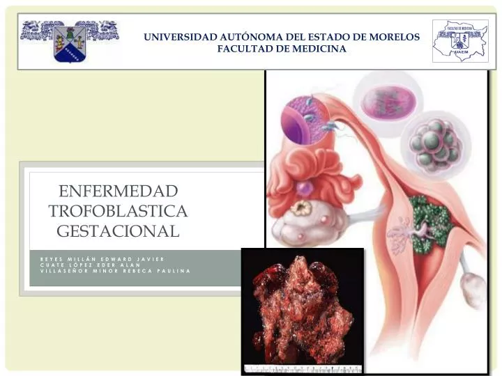 enfermedad trofoblastica gestacional