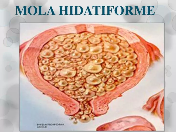 mola hidatiforme