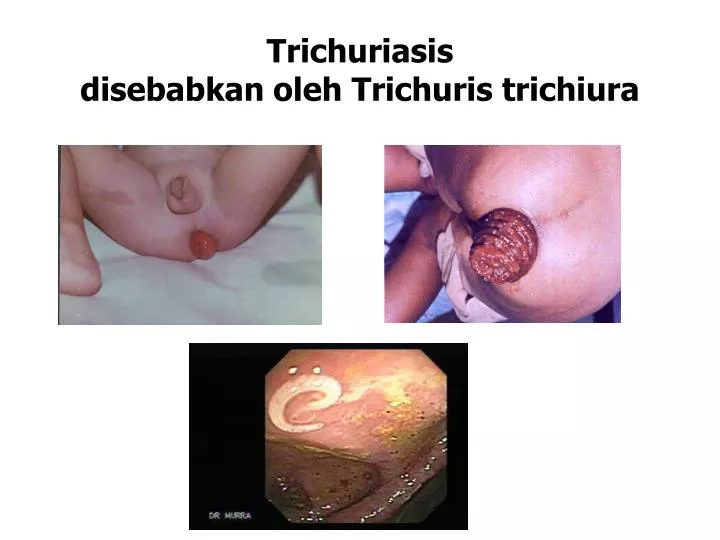 trichuriasis disebabkan oleh trichuris trichiura