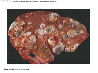 Figure 18.01 Tumors in human liver.