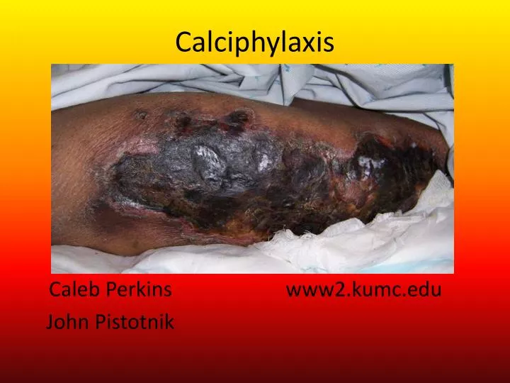 calciphylaxis