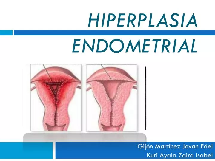 hiperplasia endometrial
