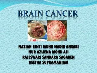 BRAIN CANCER
