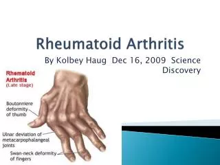 Rheumatoid Arthritis