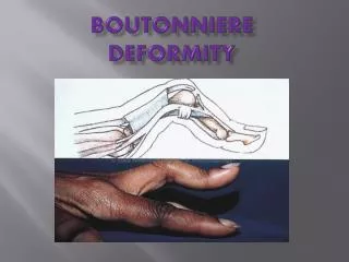 Boutonniere Deformity
