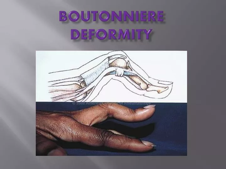 boutonniere deformity