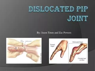 Dislocated Pip Joint