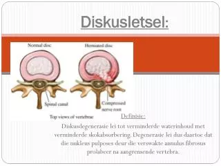 diskusletsel