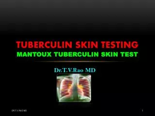 Tuberculin skin Testing Mantoux tuberculin skin test
