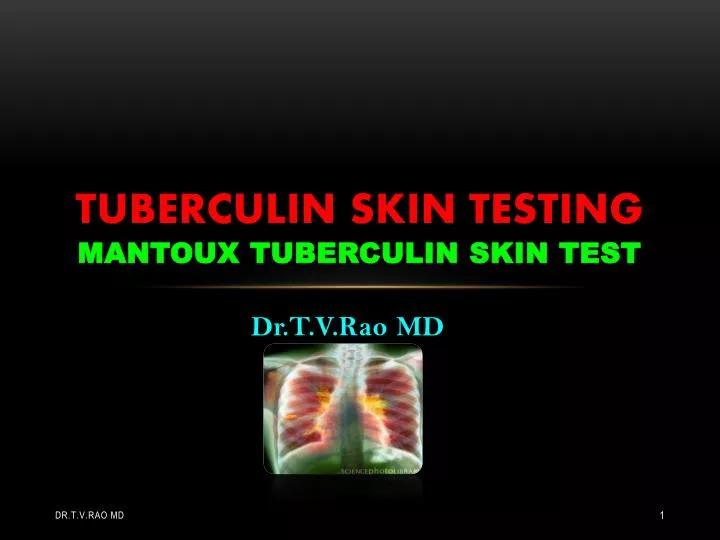 tuberculin skin testing mantoux tuberculin skin test