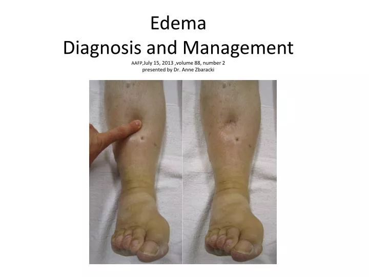 edema diagnosis and management aafp july 15 2013 volume 88 number 2 presented by dr anne zbaracki