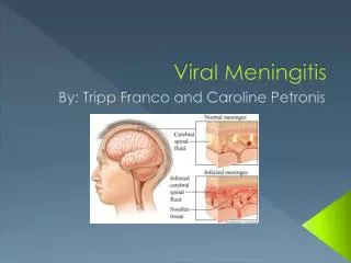 Viral Meningitis