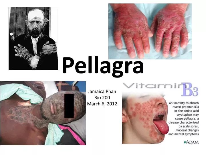 pellagra