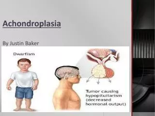 Achondroplasia By Justin Baker