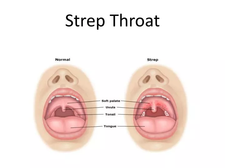 strep throat