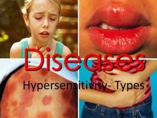 Diseases Hypersensitivity- Types