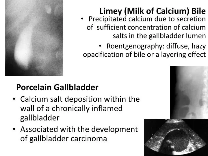 limey milk of calcium bile