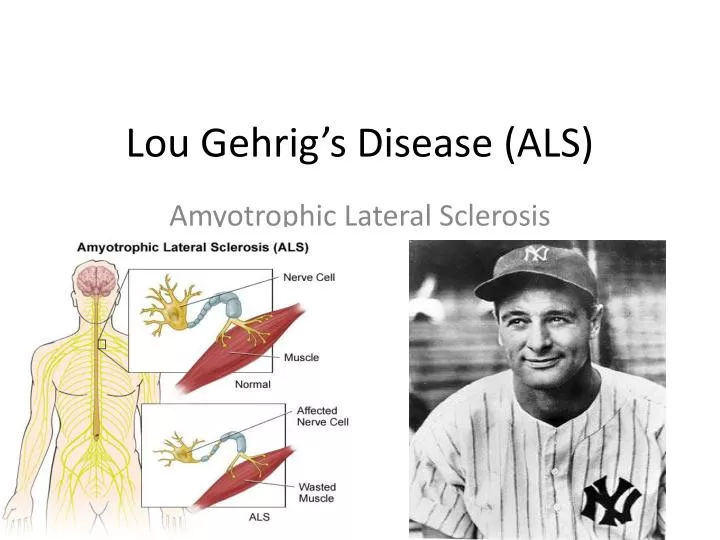 lou gehrig s disease als