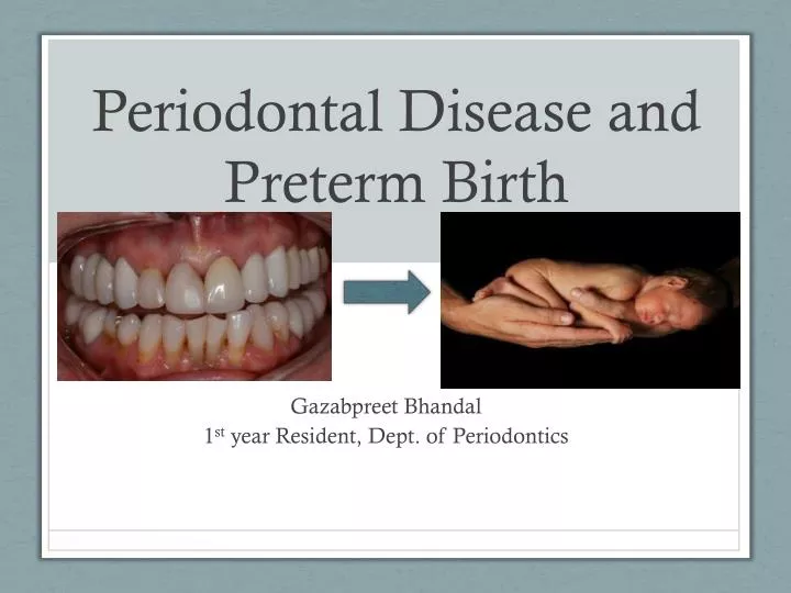 periodontal disease and preterm birth