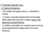 B. Subdural Hematoma : Mechanism