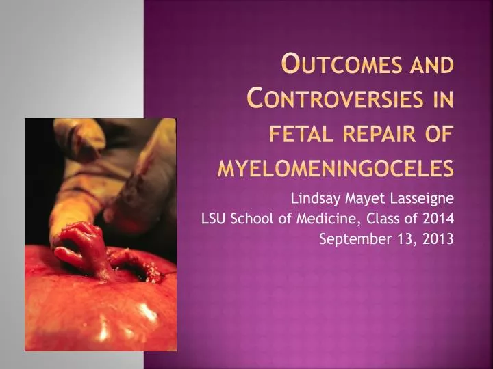 outcomes and controversies in fetal repair of myelomeningoceles