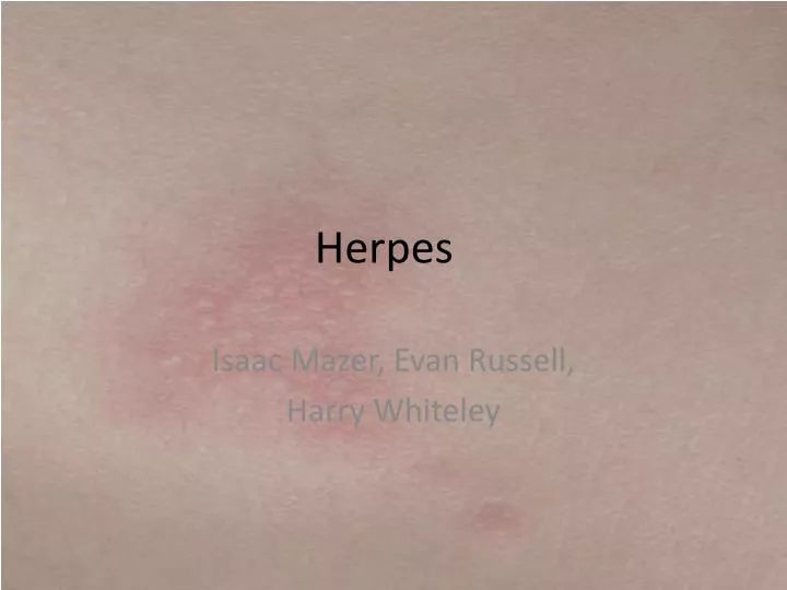 herpes